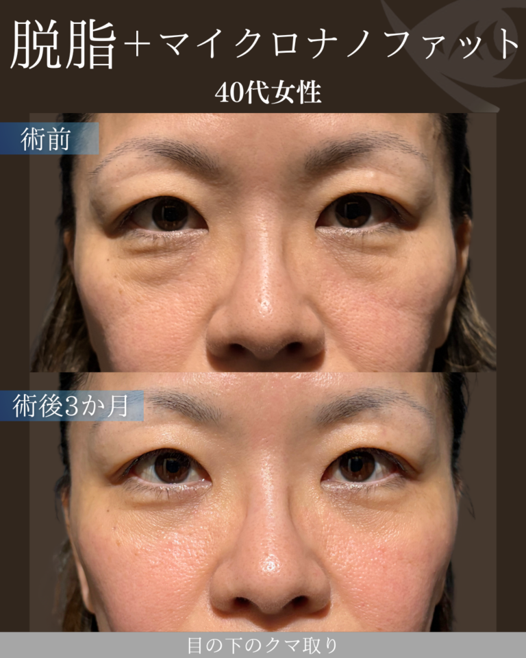 40代女性 脱脂マイクロナノファット 術後3ヶ月